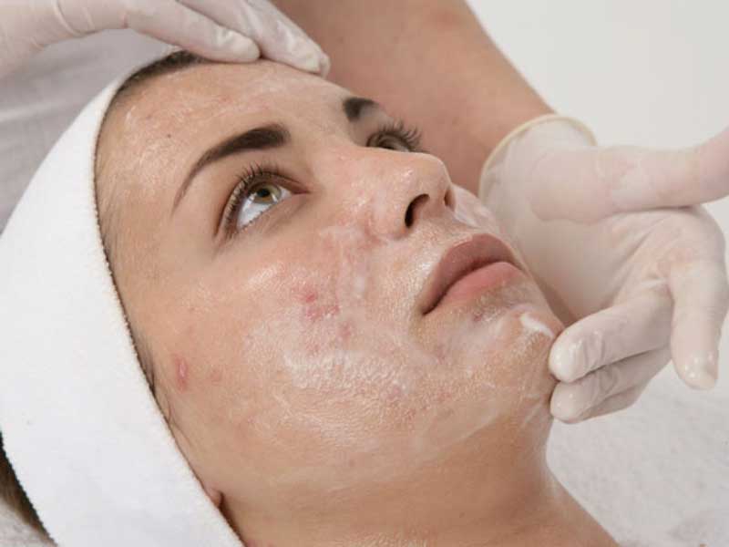 Acne Chemical Peel